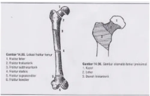 Gambar 2.2 Anatomi Lokasi Fraktur Femur  2.4.1  Fraktur leher femur 