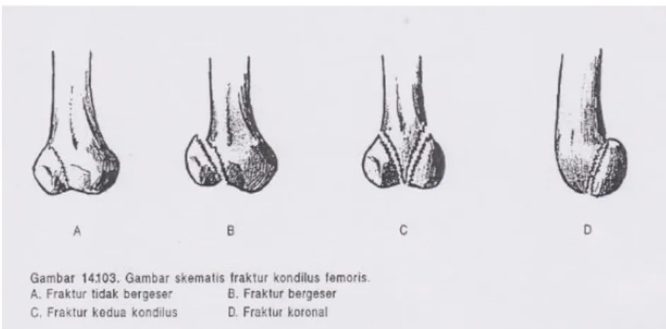 Gambar 2.8 Klasifikasi Fraktur Kondilus Femoris 