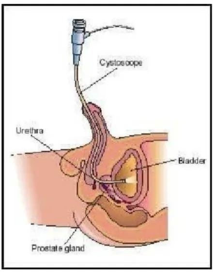 Gambar 4. Prosedur sistoskopi.