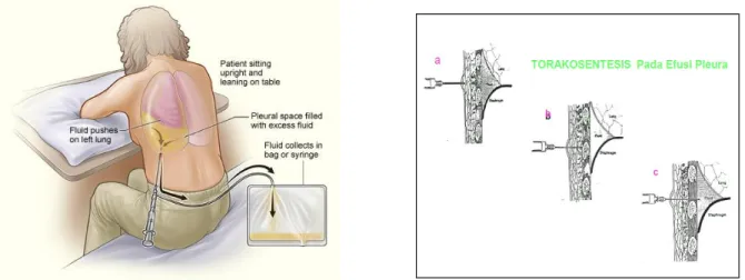 Gambar  Metode torakosentesis 