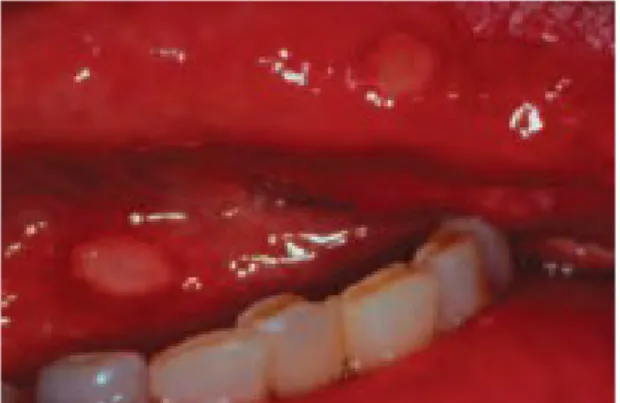 Gambar 3.1 RAS pada lidah dan dasar mulut
