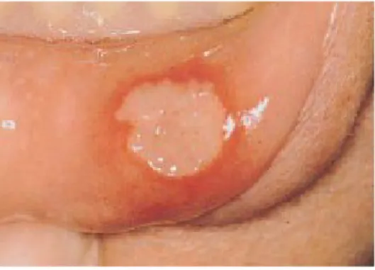 Gambar 3.3 Ulser aftosa mayor pada bibir bawah