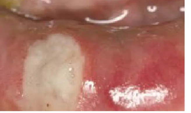 Gambar 3.7 Ulser oral pada penderita Behçet’s syndrome 3. Herpes simpleks virus (HSV)