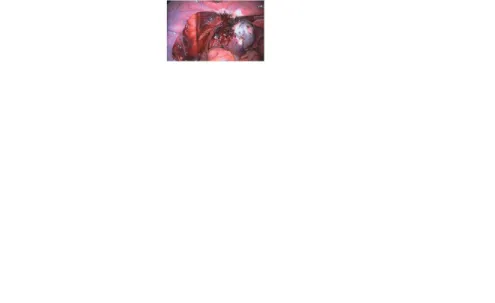 Gambar 2.5. Ligamen utero-ovarian dikoagulasi
