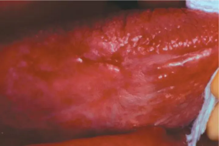 Gambar 9. Lesi lichenoid karena obat-obatan yang berupa plak berwarna merah-keputihan  pada sisi lateral lidah 7