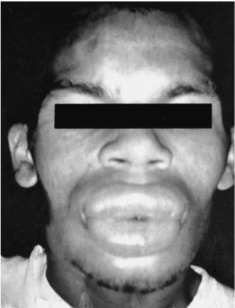 Gambar 11. Edema pada bibir akibat reaksi alergi terhadap penisilin 7