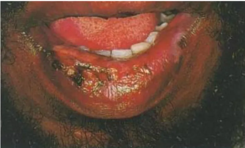 Gambar 3. Eritema multiform pada bibir yang bengkak dan terdapat krusta 8
