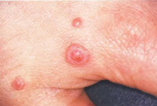 Gambar 5. Lesi target atau iris lesion pada kulit yang menjadi ciri khas eritema multiform 11 