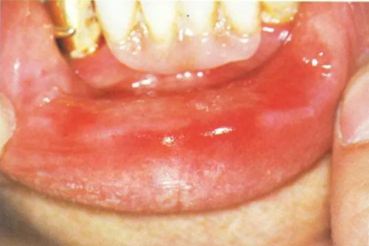 Gambar 6. Stomatitis akibat kontak alergi dengan resin akrilik 8