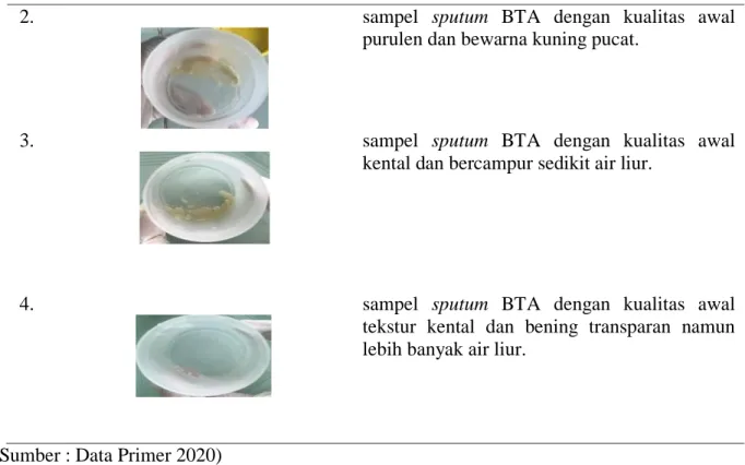 Tabel  7.    Hasil  pemeriksaan  mikroskopis  pengaruh  penyimpanan  sputum  BTA  dengan  variasi waktu penundaan 