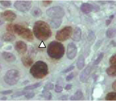 Gambar 1. Butiran AgNOR berwarna hitam yang ditunjukkan dengan tanda panah putih,   di dalam inti sel kanker servik sebelum radioterapi (perbesaran 10 x 40)