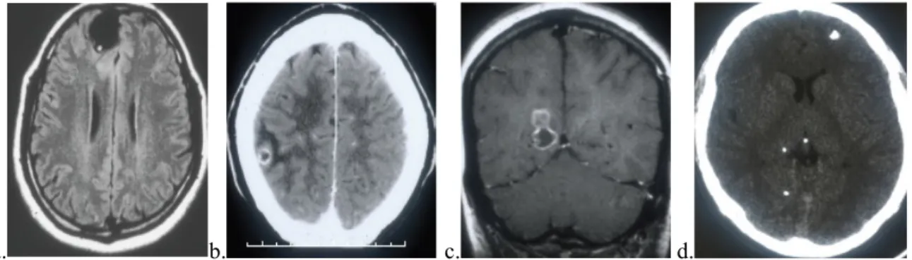 Gambar 2. Gambaran imajing neurosistisarkosis yang patognomonik pada MRI berupa hole with dot (a),  dengan edema di sekitarnya pada CT scan (b), jelas terlihat pada MRI flair (c), dan adanya kalsifikasi pada CT 