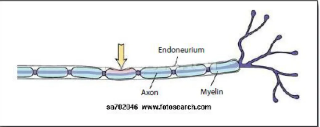 Gambar 2.1. Neuropraksia 