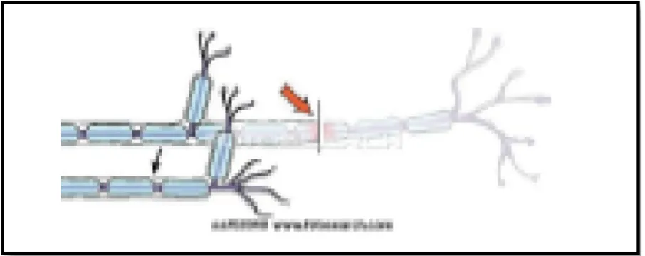 Gambar 2.3. Neurotmesis 