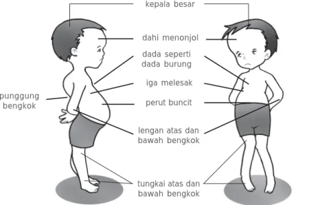 Gambar 1.12 Penderita rakitis
