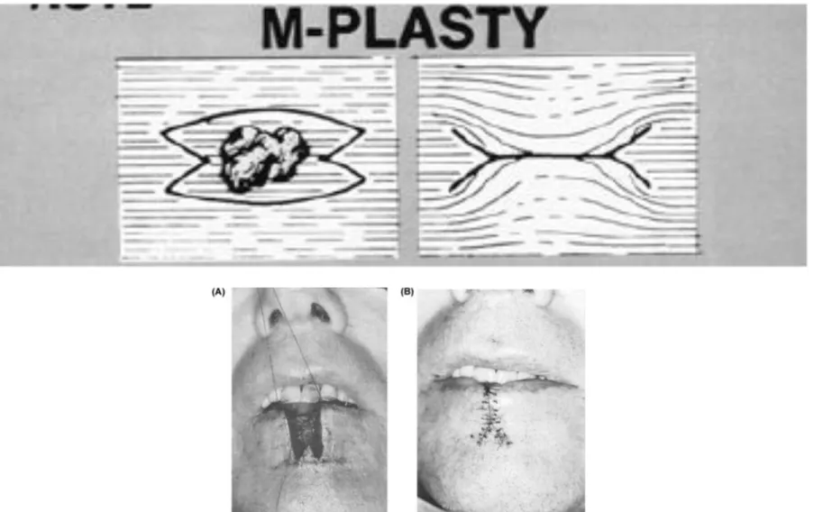 Gambar M - Plasty 
