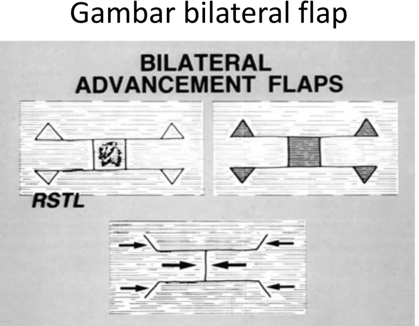 Gambar bilateral flap 