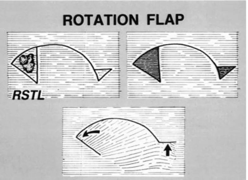 Gambar Rotation Flap 