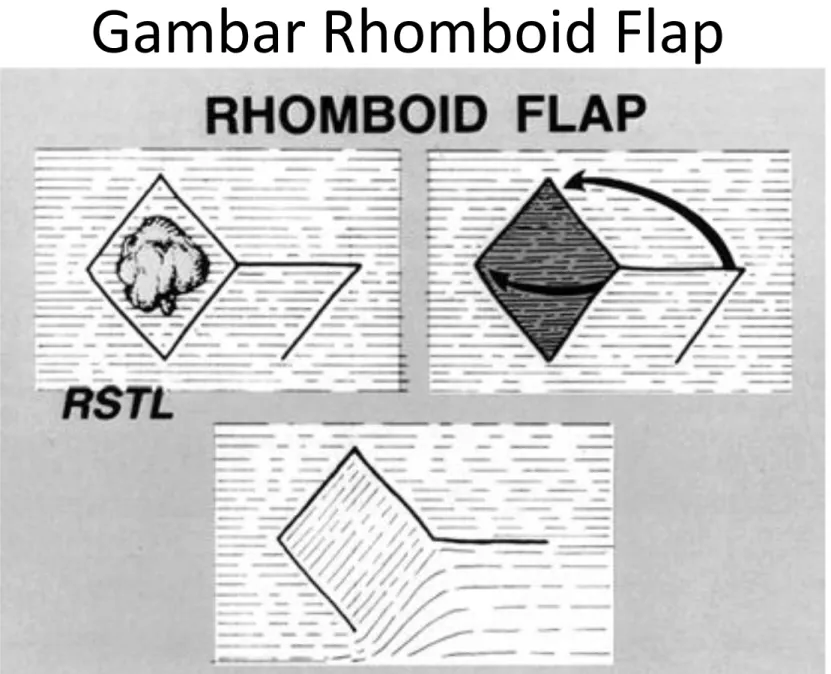 Gambar Rhomboid Flap 