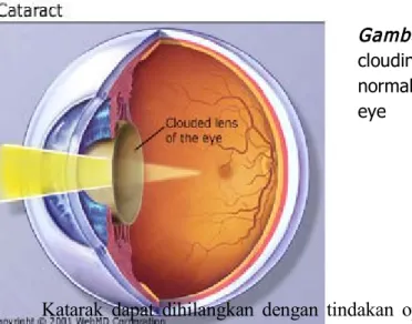 Gambar 4.   A cataract is a  clouding or fogging of the  normally clear lens of the  eye