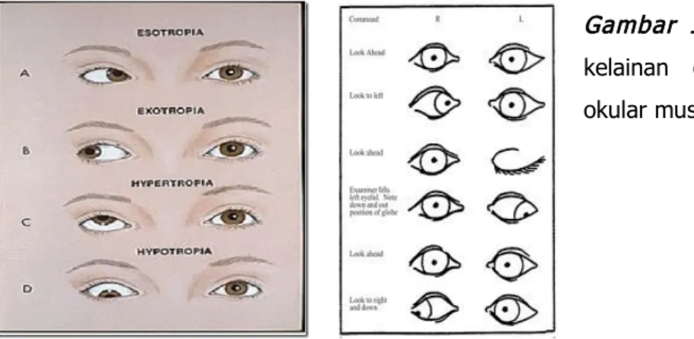 Gambar 10.  (a) Kepala saraf optic normal (b)Kepala saraf optic pada  pasien dengan NAION