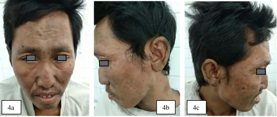 Gambar  4a.  Makula  dan  patch  hiperpigmentasi  pada  regio  fasialis,  serta  madarosis  pada  kedua  alis  mata  Gambar 4b