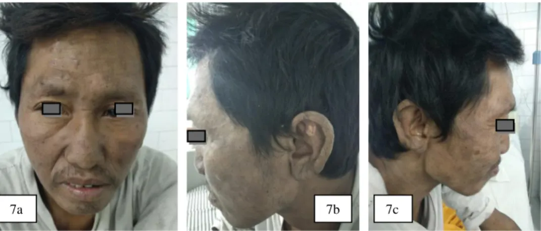 Gambar  7a.  Makula  dan  patch  hiperpigmentasi  pada  regio  fasialis,  serta  madarosis  pada  kedua  alis  mata  Gambar 7b
