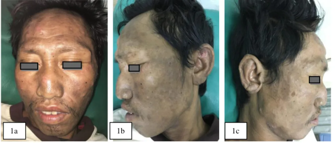 Gambar  1a.  Makula  dan  patch  hiperpigmentasi,  nodul  eritema  pada  regio  fasialis,  serta  madarosis  pada  kedua  alis  mata  Gambar  1b