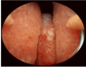 Gambar 6. Gambaran Sistoskopi Benigna Prostat Hiperplasia d Ultrasonografi trans abdominal 