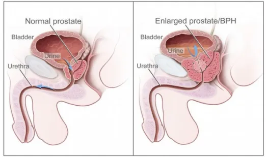 Gambar 3. Benign Prostat Hyperplasia IV. ETIOLOGI