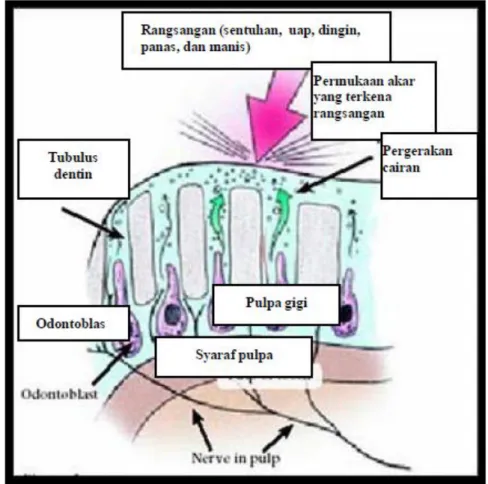 Gambar 2. Ilustrasi mekanisme teori hidrodinamik yang diawali oleh adanya rangsangan  terhadap syaraf intradental dan akhirnya menimbulkan rasa sakit/nyeri  