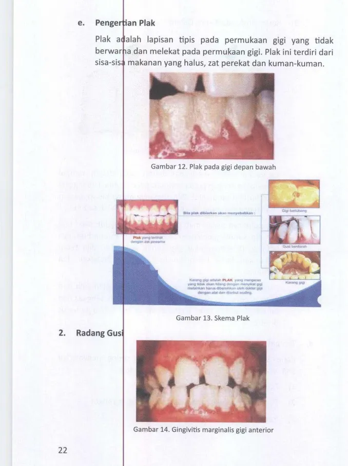 Gambar 12. Plak pada gigi depan bawah 