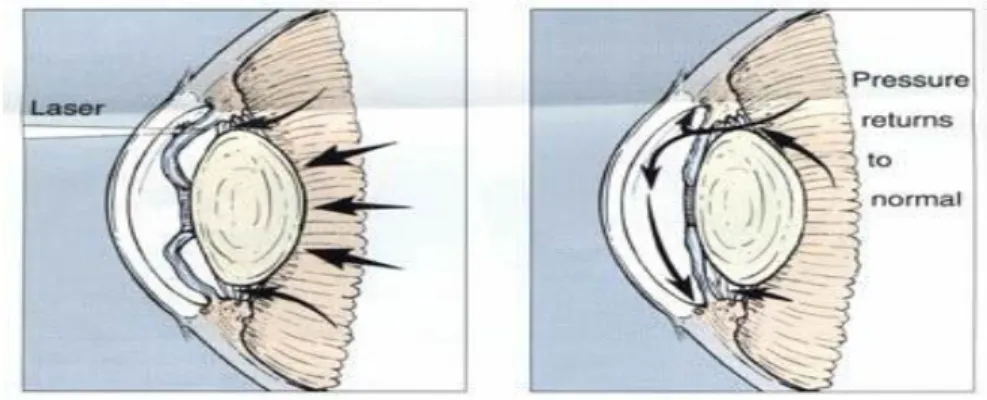 Gambar : Laser iridektomi   