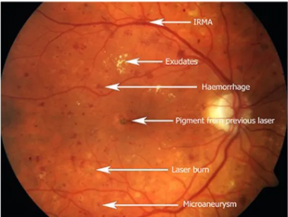 Gambar 12. Gambaran FFA pada Retinopathy DM