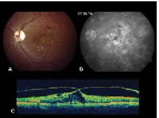 Gambar 13. Optical Coherence Tomography Menunjukaan Abnormalitas Ketebalan Retina