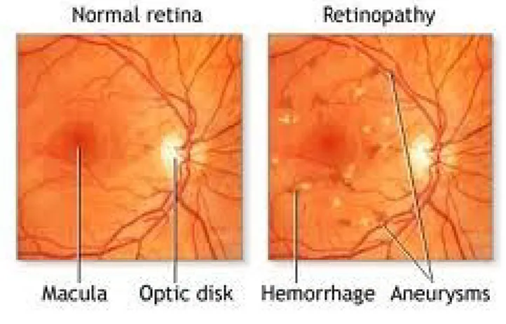 Gambar 2. Normal Retina dibandingkan Retinopati Diabetik
