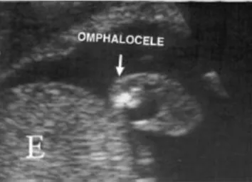 Gambar 3. Gambaran omfalokel pada USG kehamilan 15 minggu 