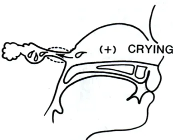 Gambar 3.1 Proses menangis dapat mengkompensasi mekanisme pembukaan tuba yang  tdk efisien pada bayi karena tuba eustakhius yang pendek dan floopy 3