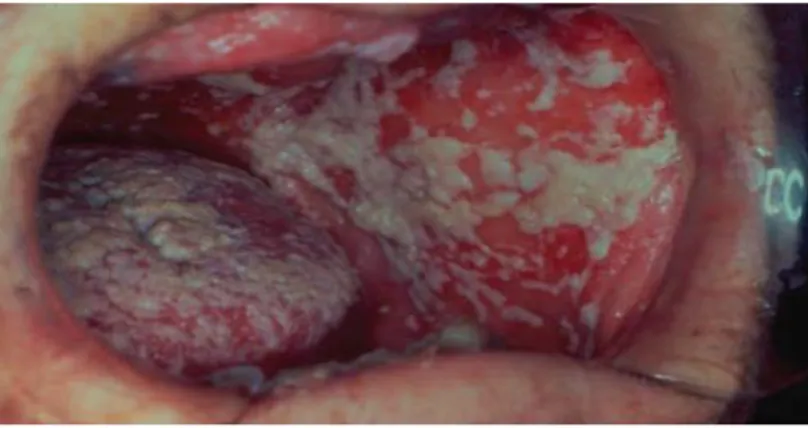 Gambar 1. Kandidiasis Pseudomembranosus Akut pada lidah dan  mukosa bukal pasien 