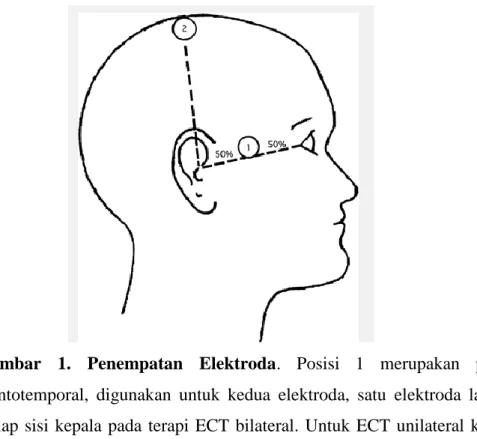 Gambar  1.  Penempatan  Elektroda.  Posisi  1  merupakan  posisi  frontotemporal,  digunakan  untuk  kedua  elektroda,  satu  elektroda  lagi  di  setiap  sisi  kepala  pada  terapi  ECT  bilateral