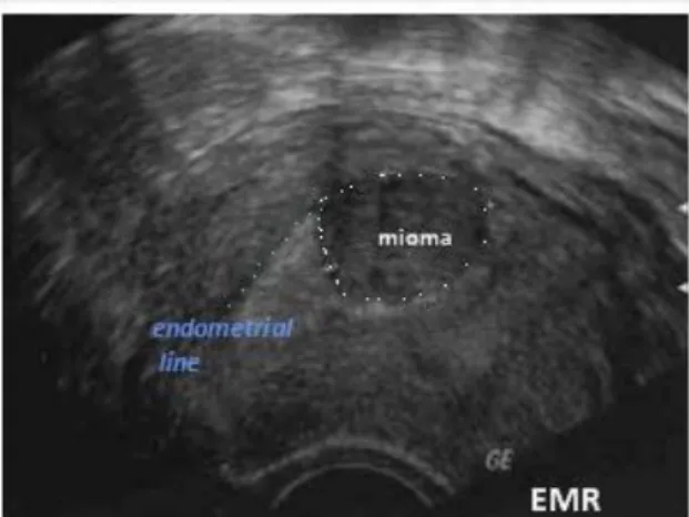 Gambar Mioma submukosa: tampak gambaran massa hipoekhoik yang  menekan endometrial line
