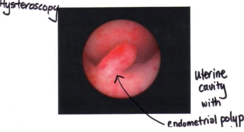 Gambar Histopatologi polip endometrium 