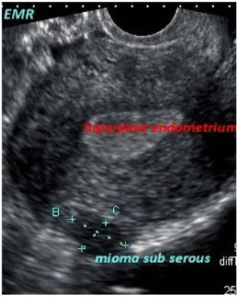 Gambar Mioma subserosa: tampak gambaran massa hipoekhoik yang  menonjol ke luar dinding uterus