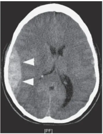 Gambar 4. CT scan dengan hasil EDH di regio temporoparietal 5