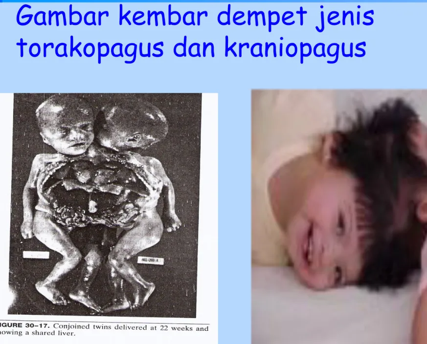 Gambar kembar dempet jenis  torakopagus dan kraniopagus 