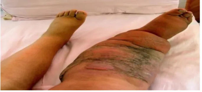 Gambar 1.3  Filariasis 