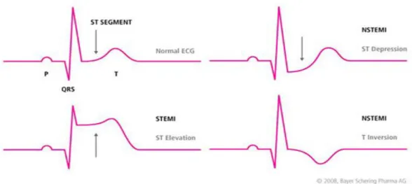 Gambar 4. Gambaran EKG STEMI dan NSTEMI 28