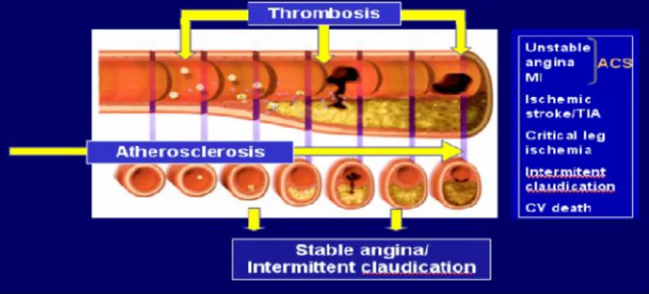 Gambar 1. Aterosklerosis 19
