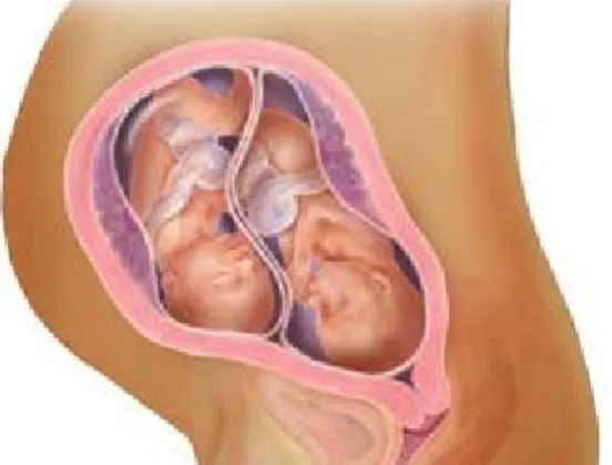 Gambar 1.Kehamilan kembar (Gemelli)
