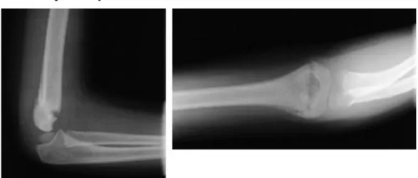 Gambar 7. Gambaran Radiologis Fraktur Supracondylar Disertai Dislokasi 